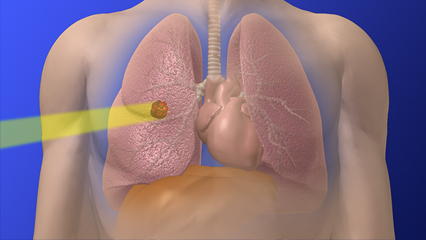 肺がん治療 肺ガン治療 肺癌治療 肺がん治療 放射線治療 気管支 心臓 肝臓 肺腫瘍 非小細胞肺がん 小細胞肺がん 根治的放射線治療