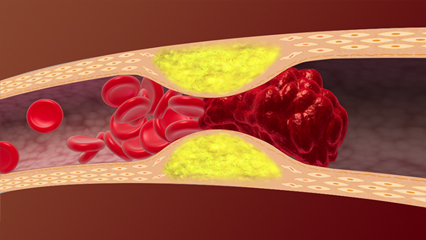 動脈硬化 血栓 アテローム硬化 頸動脈狭窄症 粥状硬化 線維性肥厚 動脈壁 脂質沈着 石灰沈着 プラーク 総脛動脈 内頸動脈 外頸動脈 脂質コア 動脈硬化 血栓 潰瘍 中膜硬化 細動脈硬化 大動脈 脳動脈 冠動脈 中性脂肪 LDLコレステロール 脂質異常 HDLコレステロール 狭心症 心筋梗塞 血栓症 脳梗塞 血栓塞栓症 血液凝固 フィブリン 赤血球