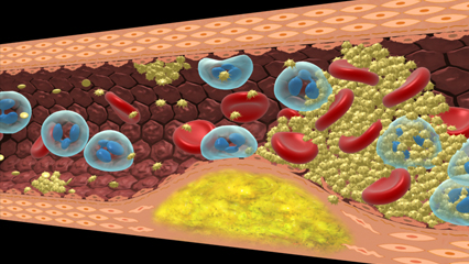 血小板凝集血栓 アテローム硬化 頸動脈狭窄症 粥状硬化 線維性肥厚 動脈壁 脂質沈着 石灰沈着 プラーク 総脛動脈 内頸動脈 外頸動脈 脂質コア 動脈硬化 血栓 潰瘍 中膜硬化 細動脈硬化 大動脈 脳動脈 冠動脈 中性脂肪 LDLコレステロール 脂質異常 HDLコレステロール 狭心症 心筋梗塞 血栓症 脳梗塞 血栓塞栓症 血液凝固 フィブリン 血小板 白血球 虚血 梗塞 赤血球 血管壁障害 高脂血症 硝子様血栓