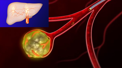 肝臓血管構造・肝動脈カテーテル治療（web）  肝動脈 総肝動脈 固有肝動脈 門脈  化学療法 塞栓療法 カテーテル ウイルス 血管新生 抗がん剤 肝臓血管　肝細胞がん